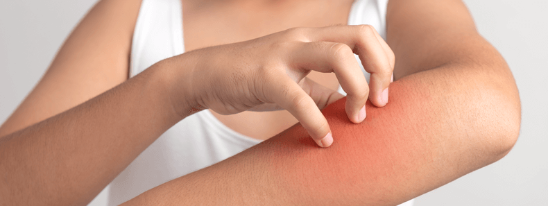 Food Sensitivities that may cause itchy skin